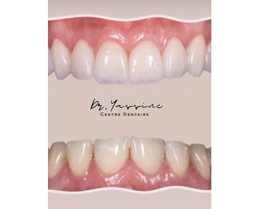 Densite Marrakech - Dentist marrakech - طبيب اسنان مراكش