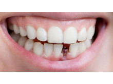 Implant dentaire casablanca