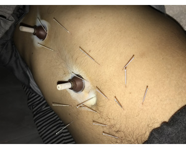 Acupuncteur Chiropracteur Ostéopathe massage sportif