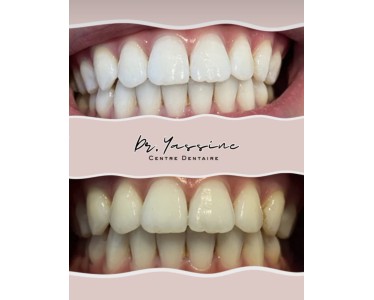 Densite Marrakech - Dentist marrakech - طبيب اسنان مراكش